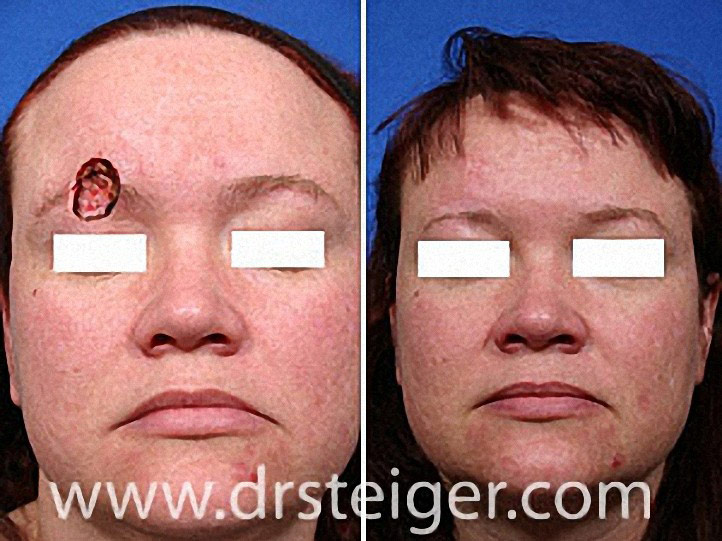 Eyebrow Repair after MOHS Surgery Steiger Facial Plastic Surgery