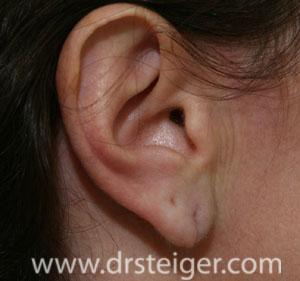 Earlobe Surgery Before and After Photos - Split Earlobe Repair