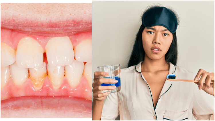 Berbeda dengan Karang Gigi, ini 6 Cara Mudah Menghilangkan Plak Gigi