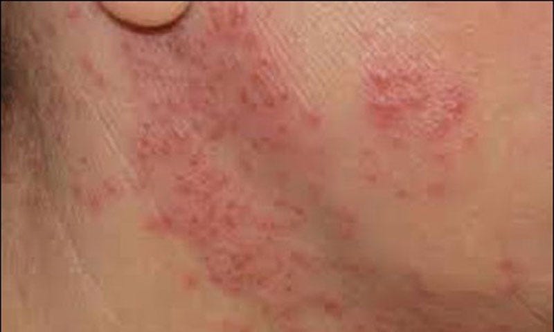 Archive of stories about Cara Cegah Herpes Genital – Medium