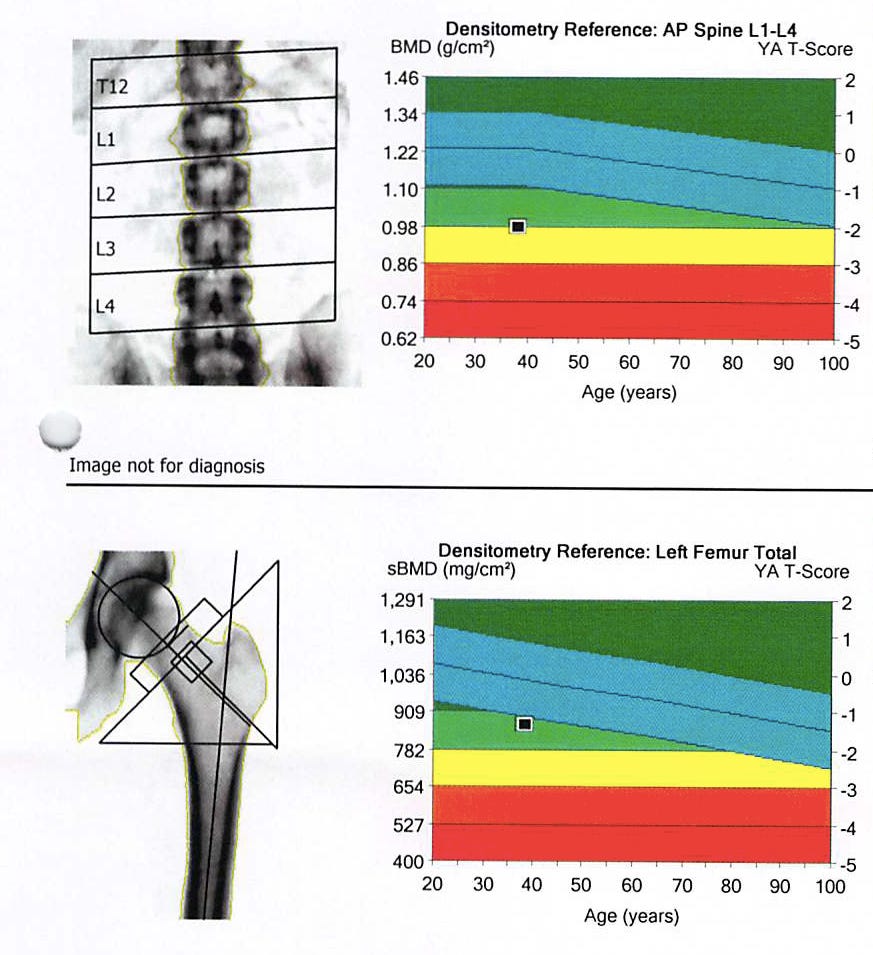 Taking on my Osteoporosis Justin Lawler Medium