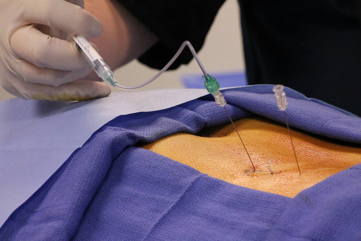 Efficacy of Epidural Steroid Injections for Treating Lower