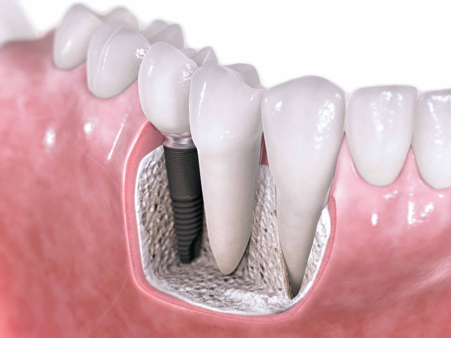 how to calculate the cost of dental implants