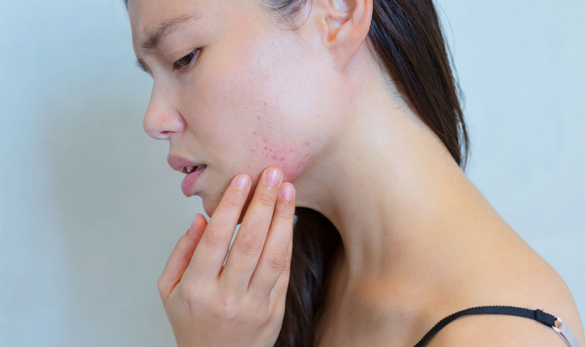 How to tell skin purging vs. breakouts apart Proactiv®