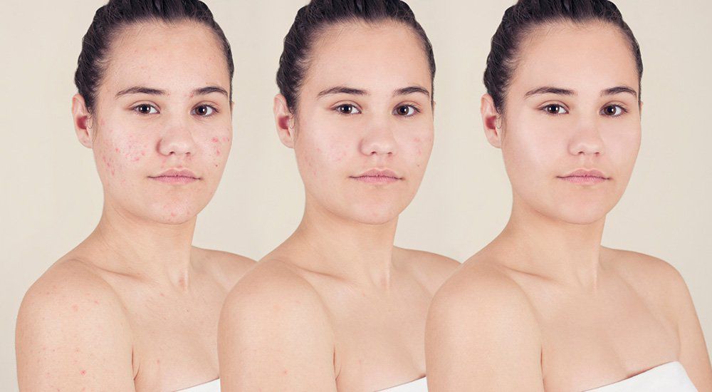 Amazon.com : Proactiv 3 Step Acne Treatment - Benzoyl Peroxide Face Wash, Repairing Acne Spot Treatment For Face And Body, Exfoliating Toner - 60 Day Complete Acne Skin Care Kit : Beauty & Personal Care Stages Of Acne And How To Get Rid Of It | Proactiv® Resource Hub