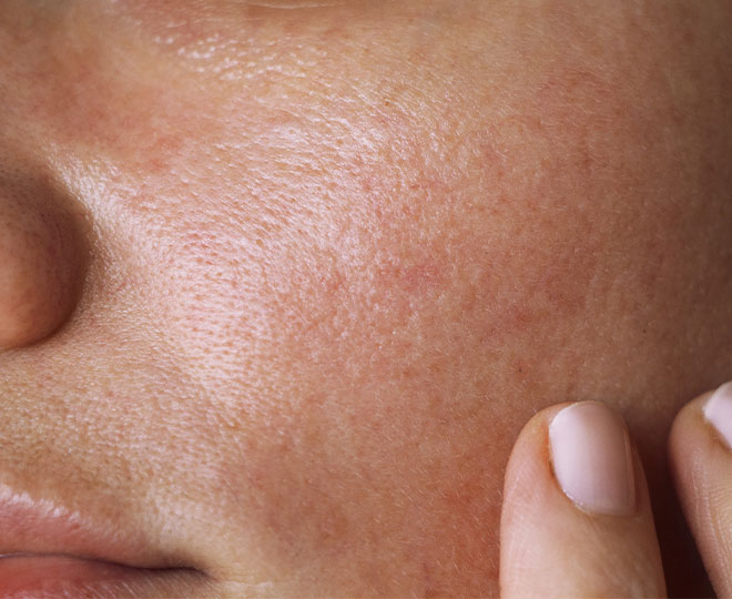 What Causes Oily Skin? Proactiv®