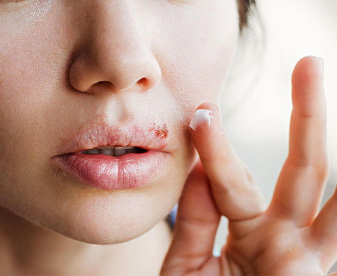 How to Get Rid of Pimple Scabs Proactiv®