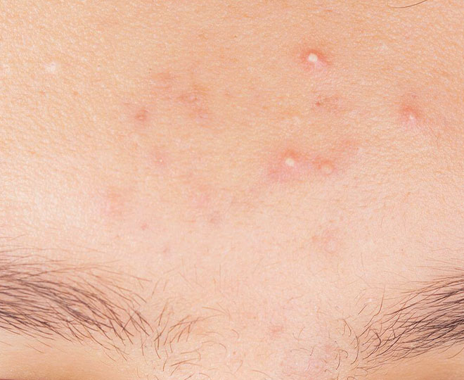 Whiteheads l What Are Whiteheads and Prevention l Proactiv