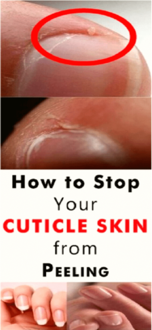 Exploring The Psychological Effects Of Cuticle Picking Is It A Form Of