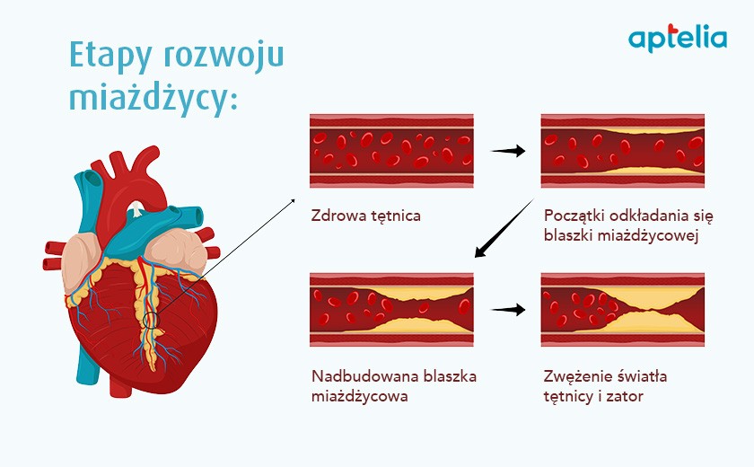 Miażdżyca ‒ czym jest i jak ją leczyć? aptelia.pl