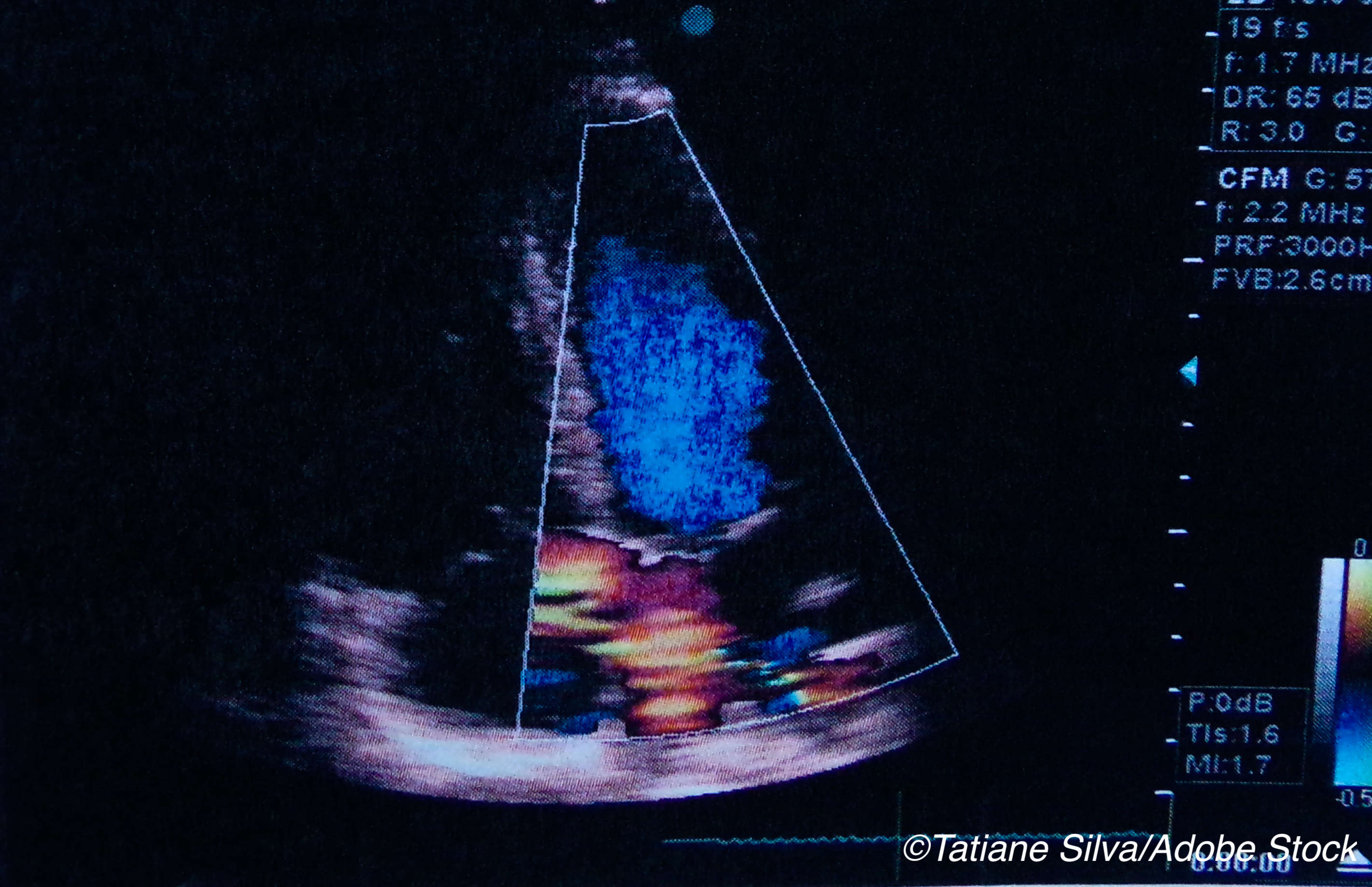 LVEF Directionality Provides Clues to HF Physician's Weekly