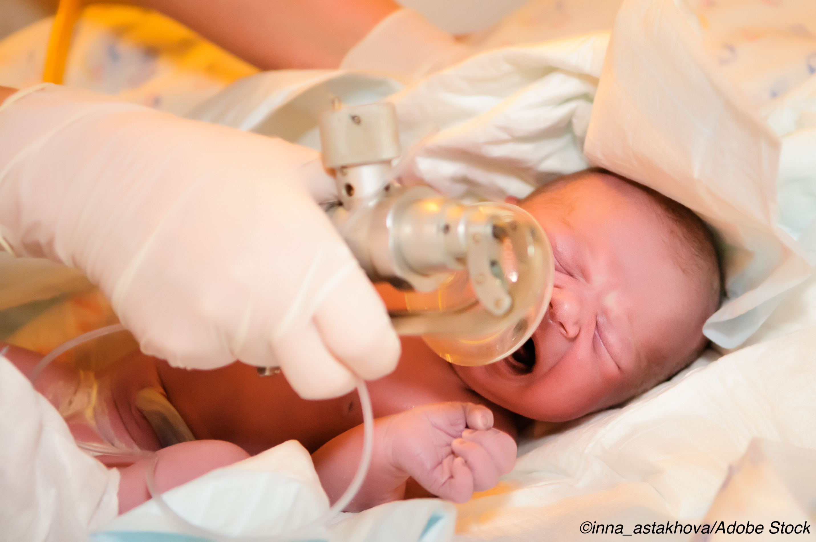 Laryngeal Mask Airway Shown to Be Safe Option for Newborn Resuscitation
