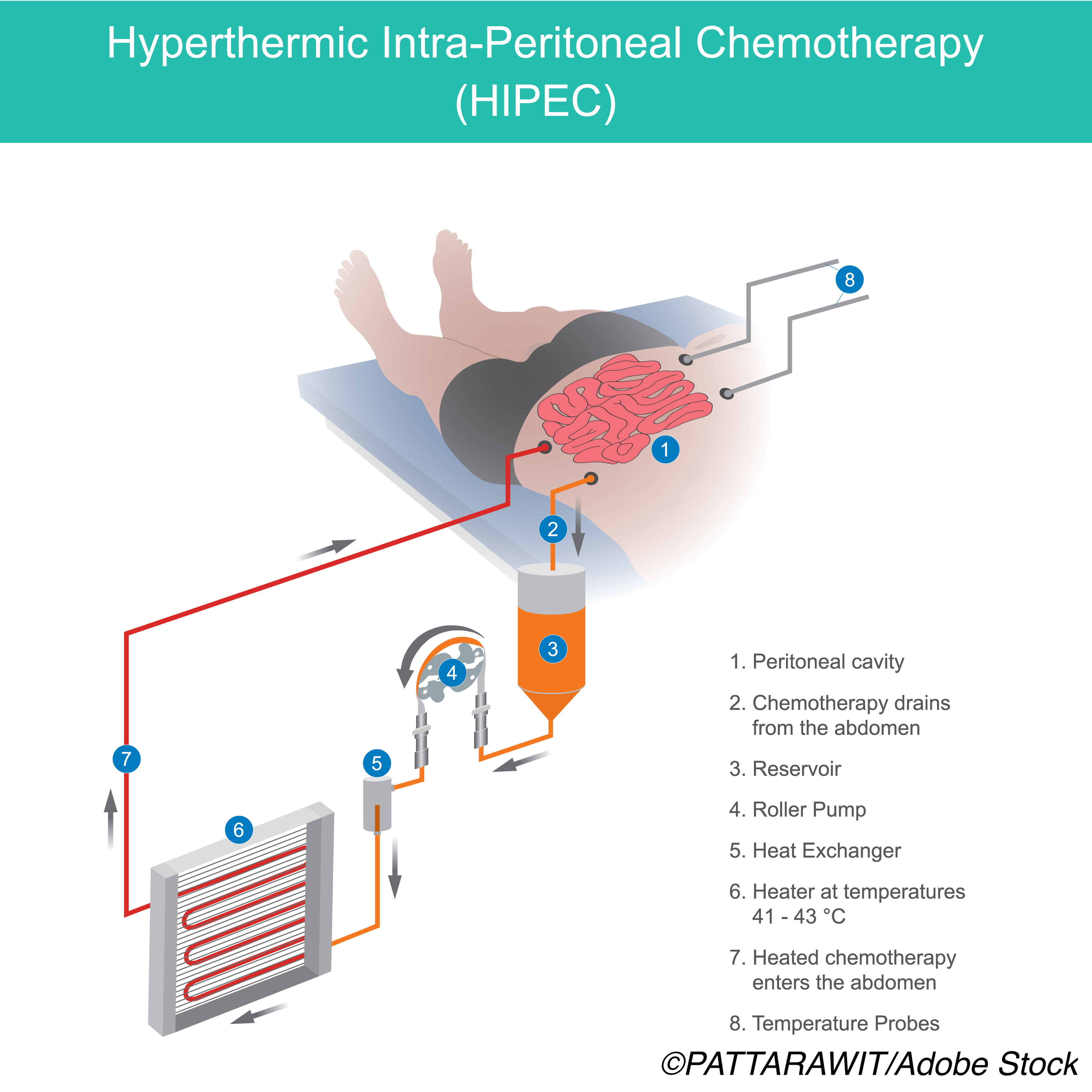 Hyperthermic Intraperitoneal Chemoperfusion