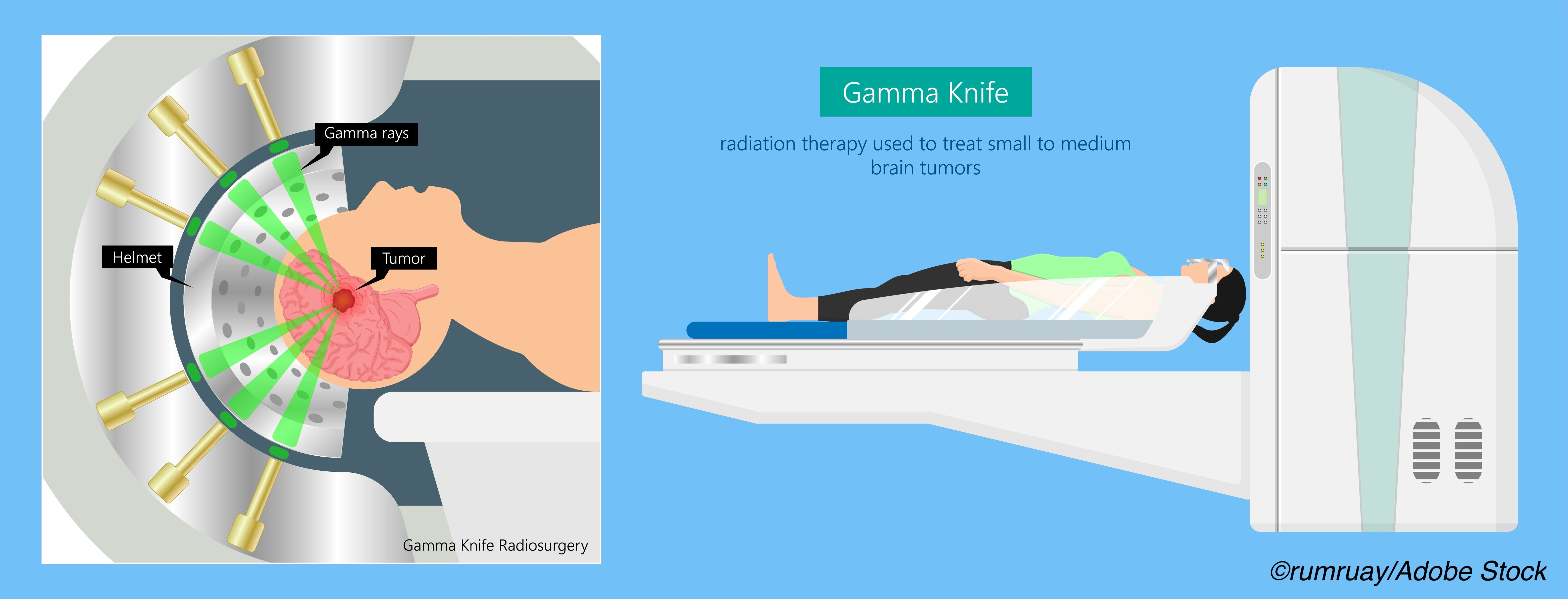 Stereotactic Body Radiotherapy Safe for Oligometastatic Patients