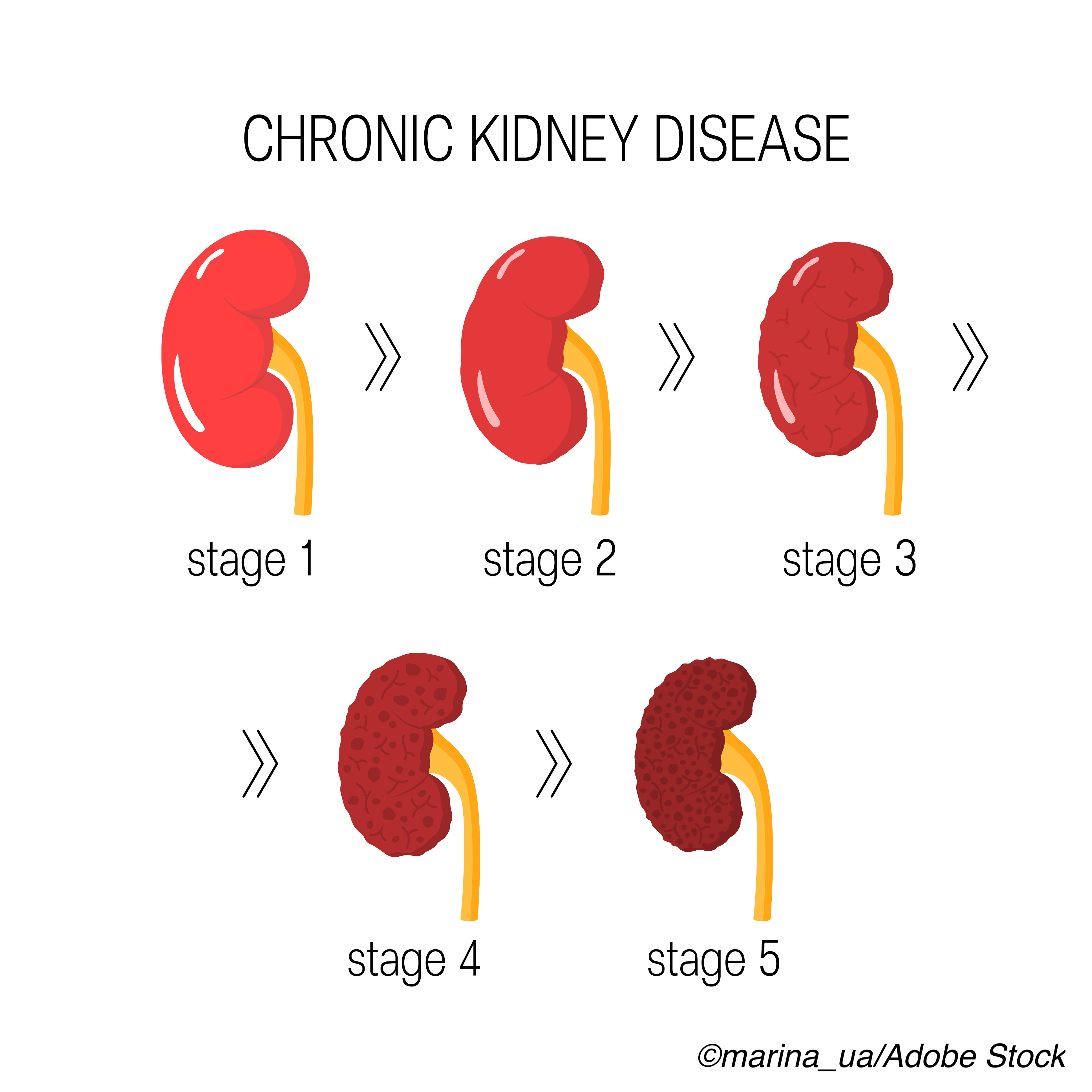 Phase III AURORA Results Confirm Efficacy of Voclosporin for Lupus
