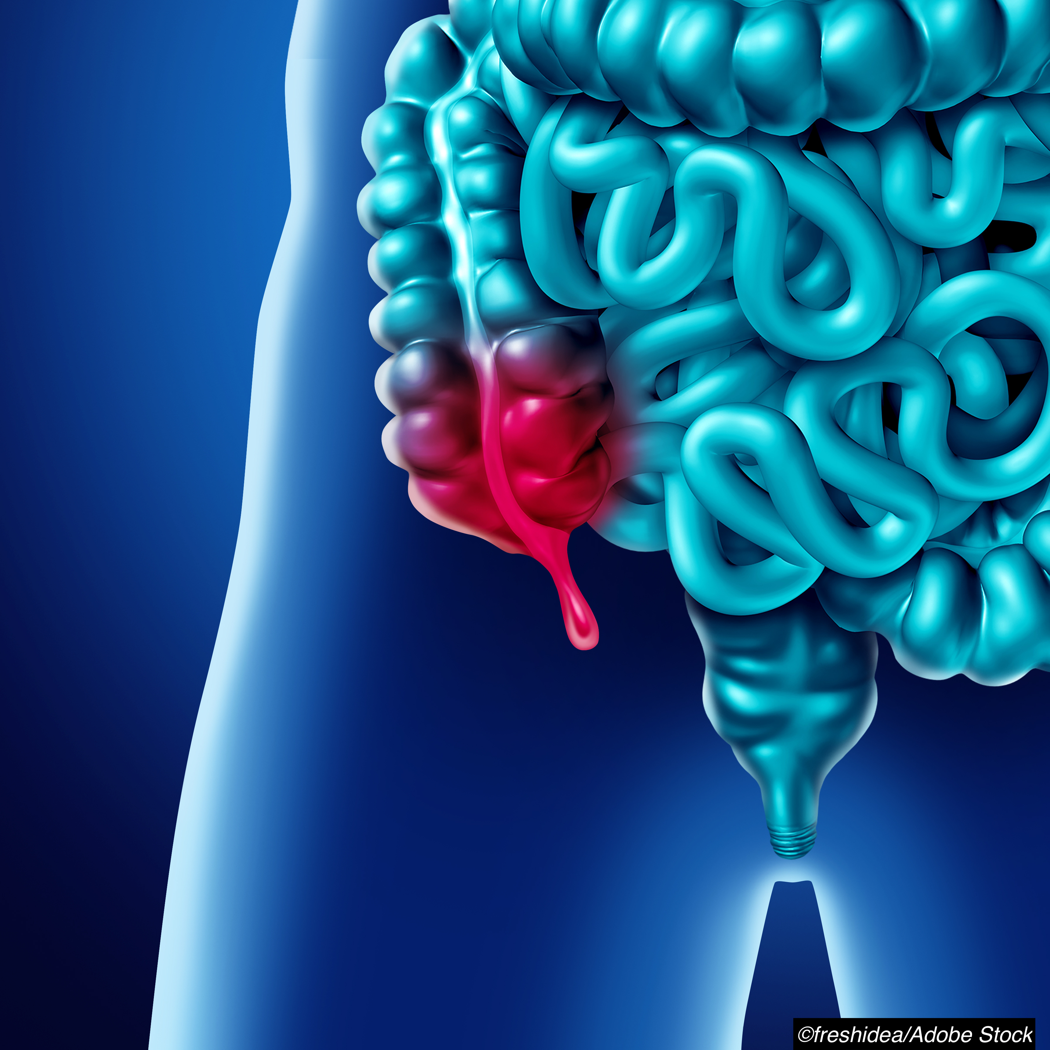 CODA Do Appendicoliths Up the Odds of Appendectomy After Antibiotics