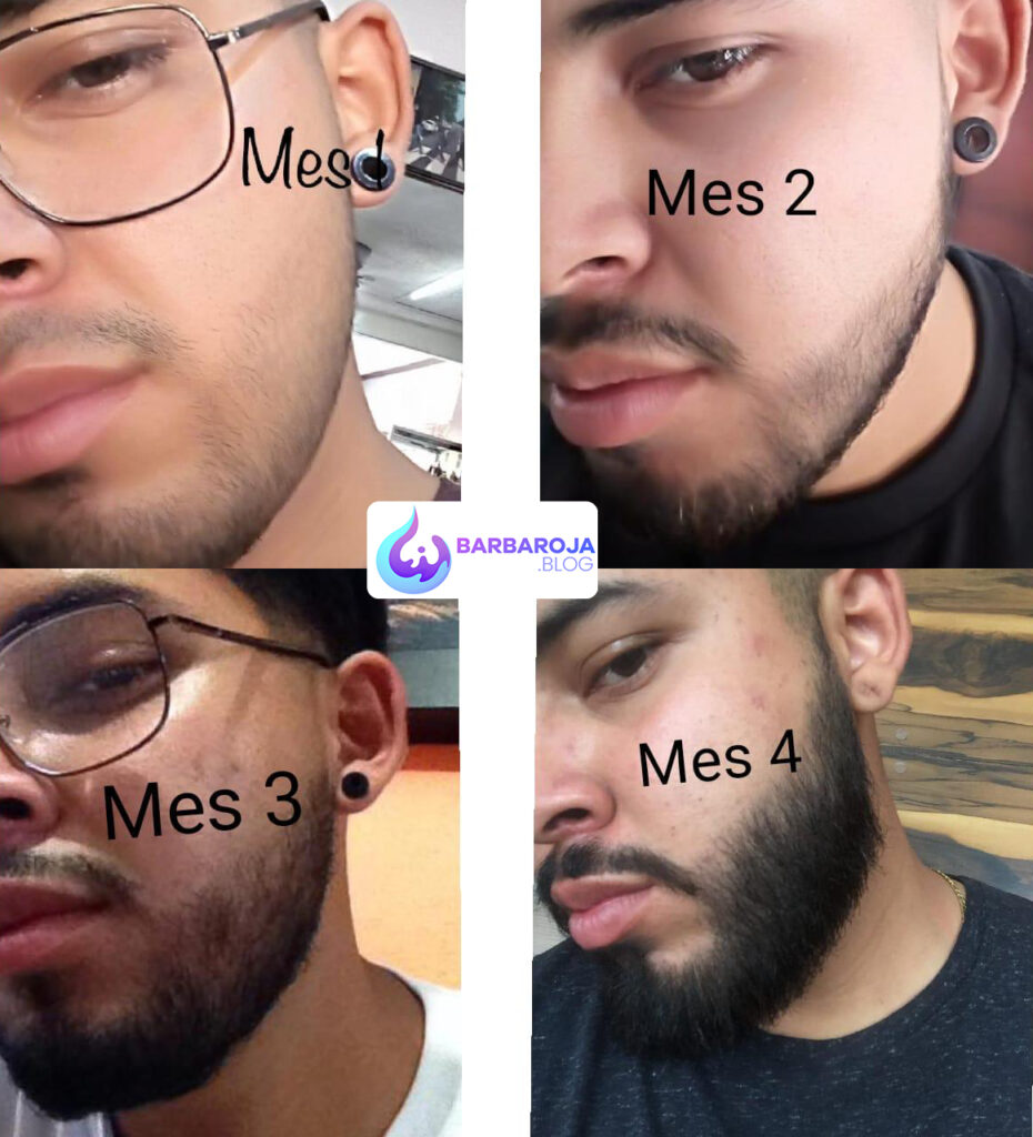 Minoxidil antes y despues Barba, cabello, entradas