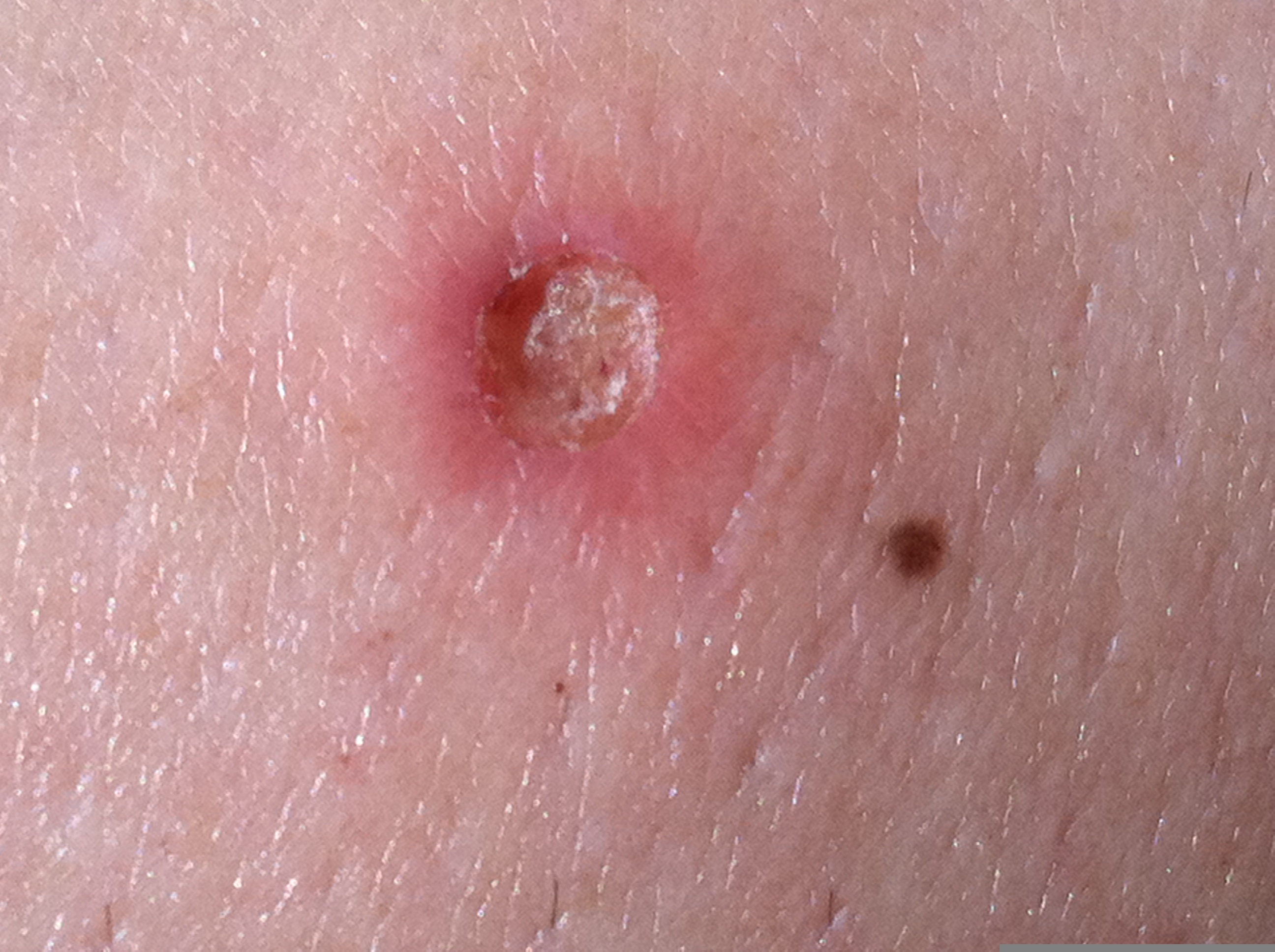 Do Bed Bugs Leave Scabs BedBugs