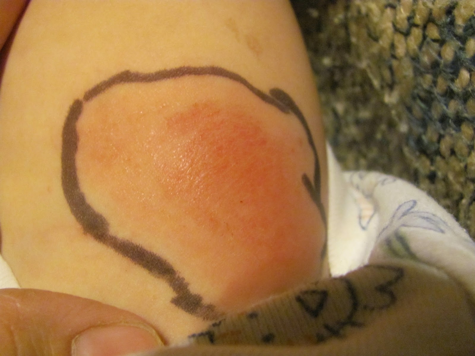 Don’t Let Bed Bugs Give You The Creeps Cellulitis And What You Need To
