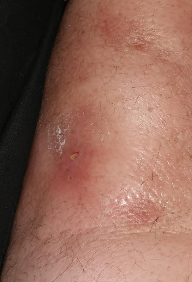 Don’t Let Bed Bugs Give You The Creeps Cellulitis And What You Need To
