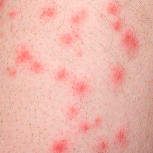 Are Bed Bug Bites Individual Bites Or Rashes BedBugs