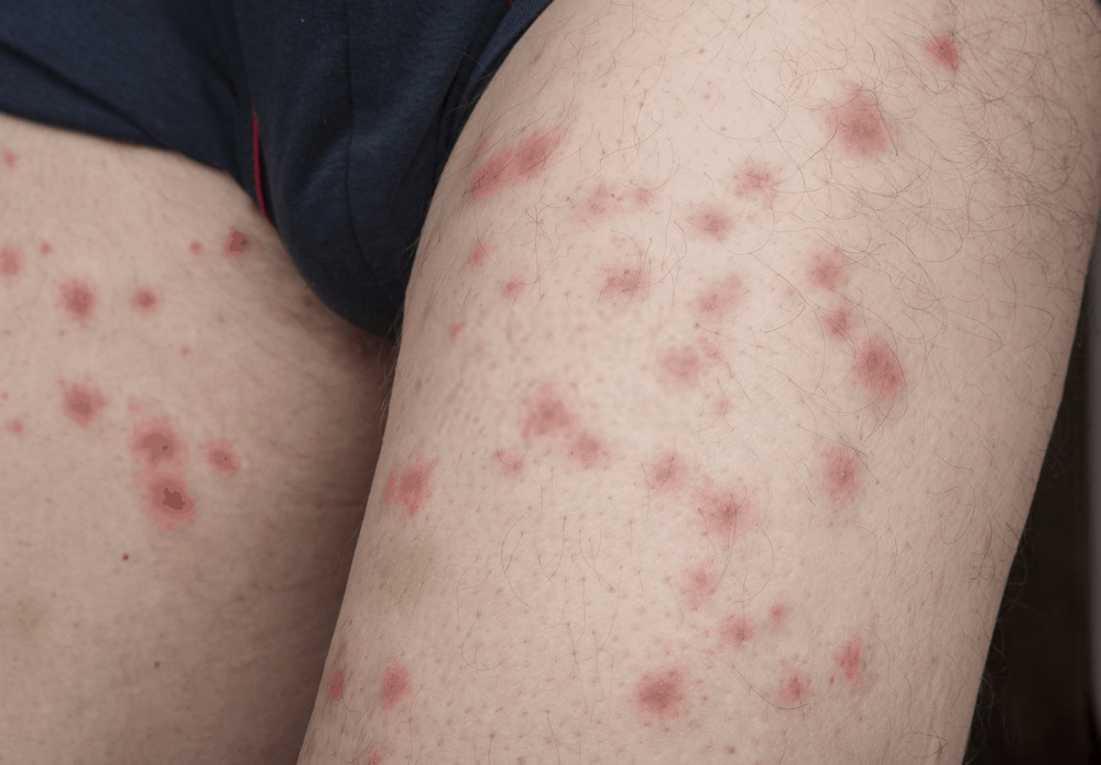 The Cause Of Your Dry Skin Could Be Bed Bug Bites BedBugs