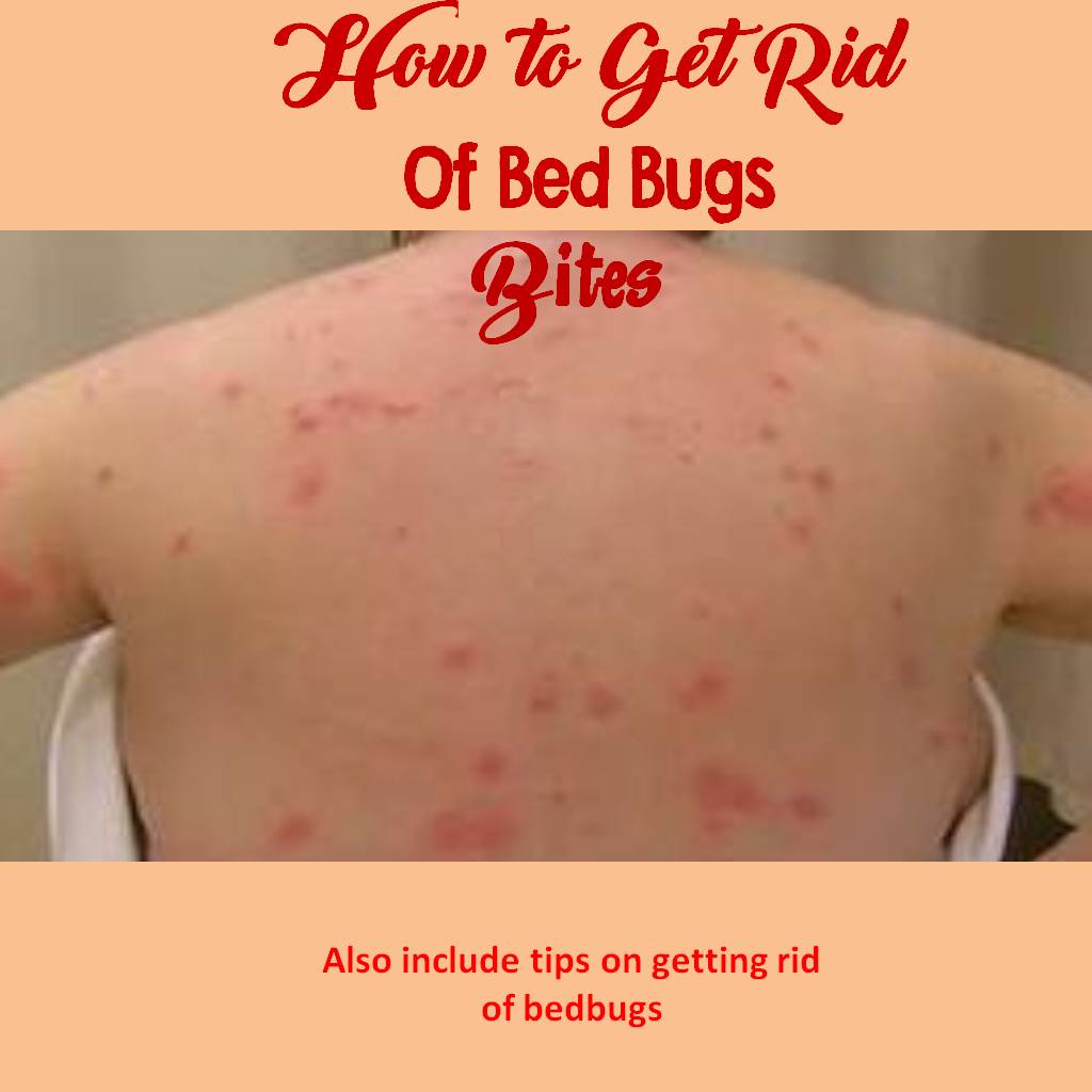 How To Use VapoRub To Stop Bed Bug Bites From Itching BedBugs