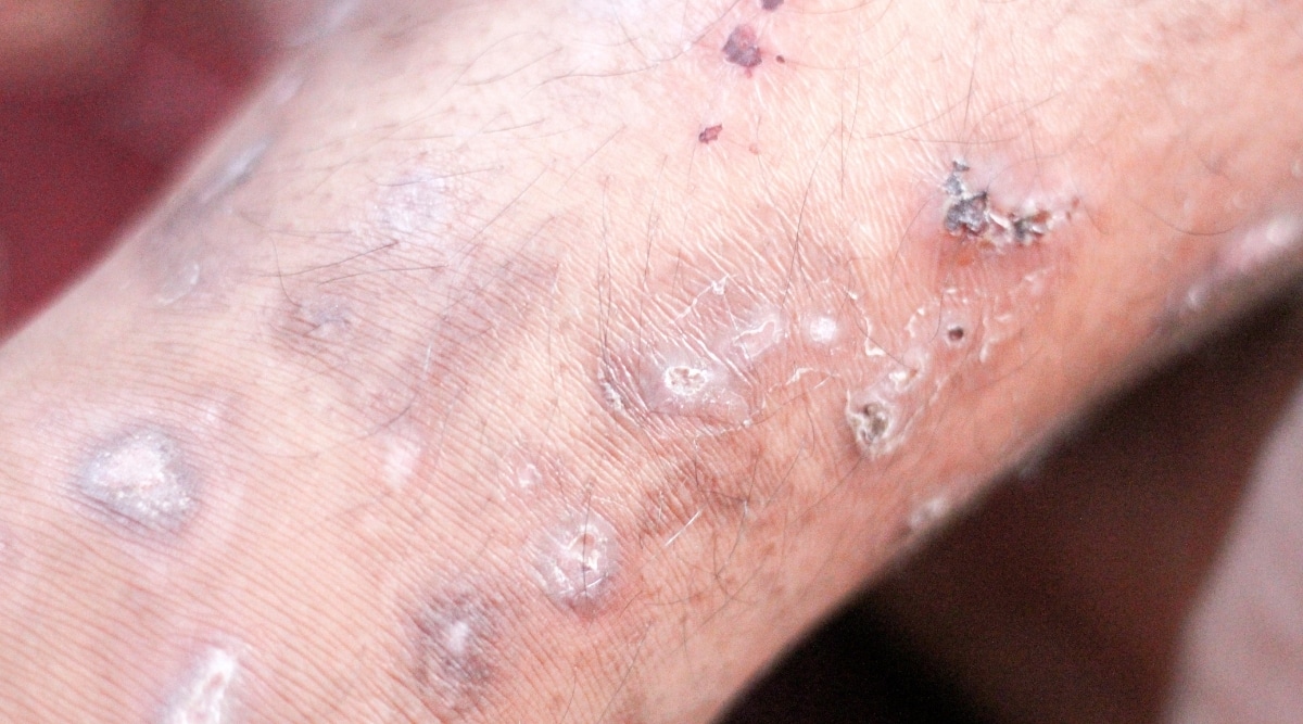 Can You Get Scabies From Bed Sheets Scabies Vs Bed Bugs How To Tell The Difference BedBugs