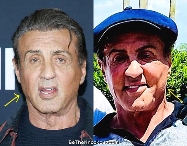 Sylvester Stallone Plastic Surgery Before And After T vrogue.co