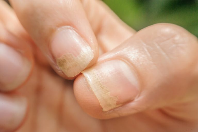 How To Get Rid Of Yellow Nails At Home Remove Or Cover Yellow Stains