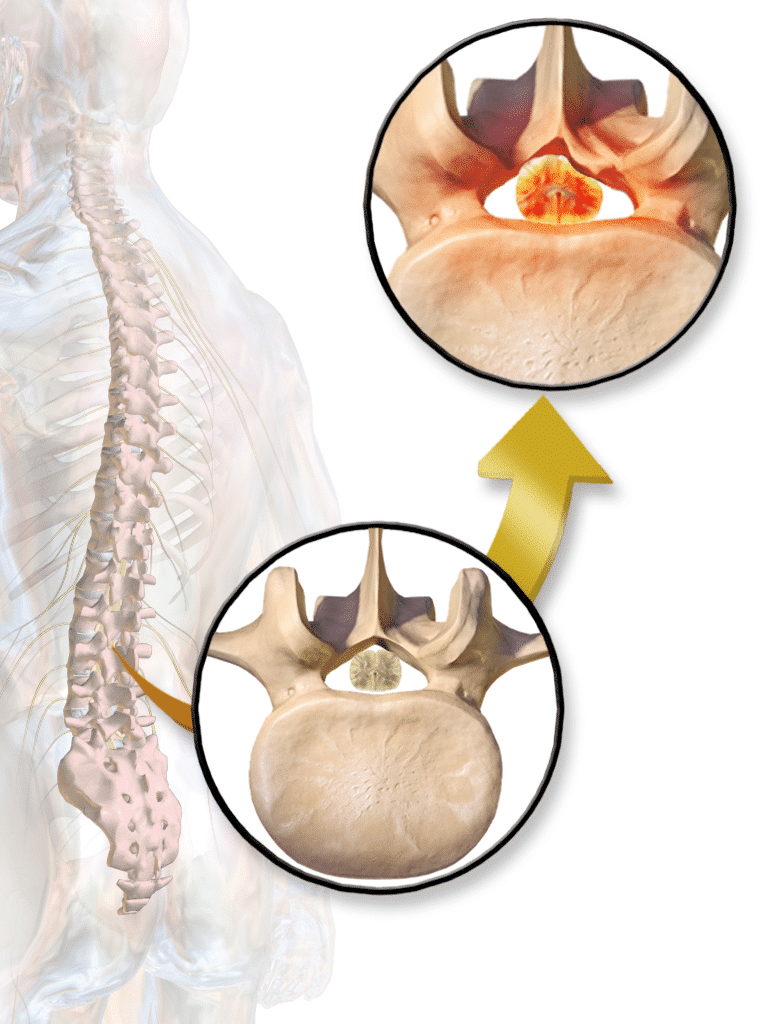 Two Types Of Shots For Treating A Herniated Disc Brandon Orthopedics