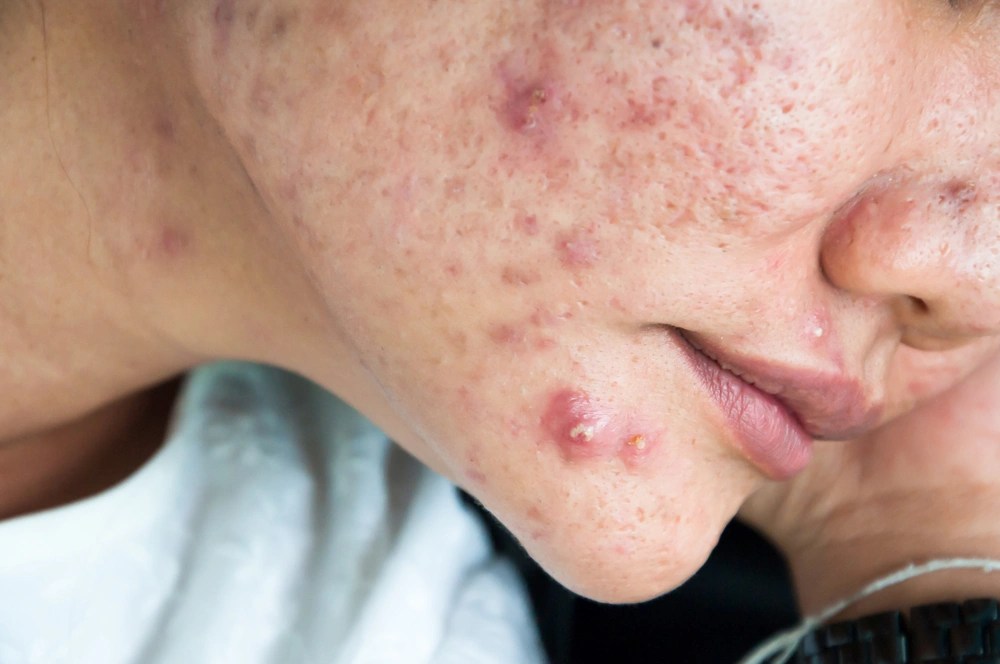 How To Tell The Difference Between Regular And Cystic Acne