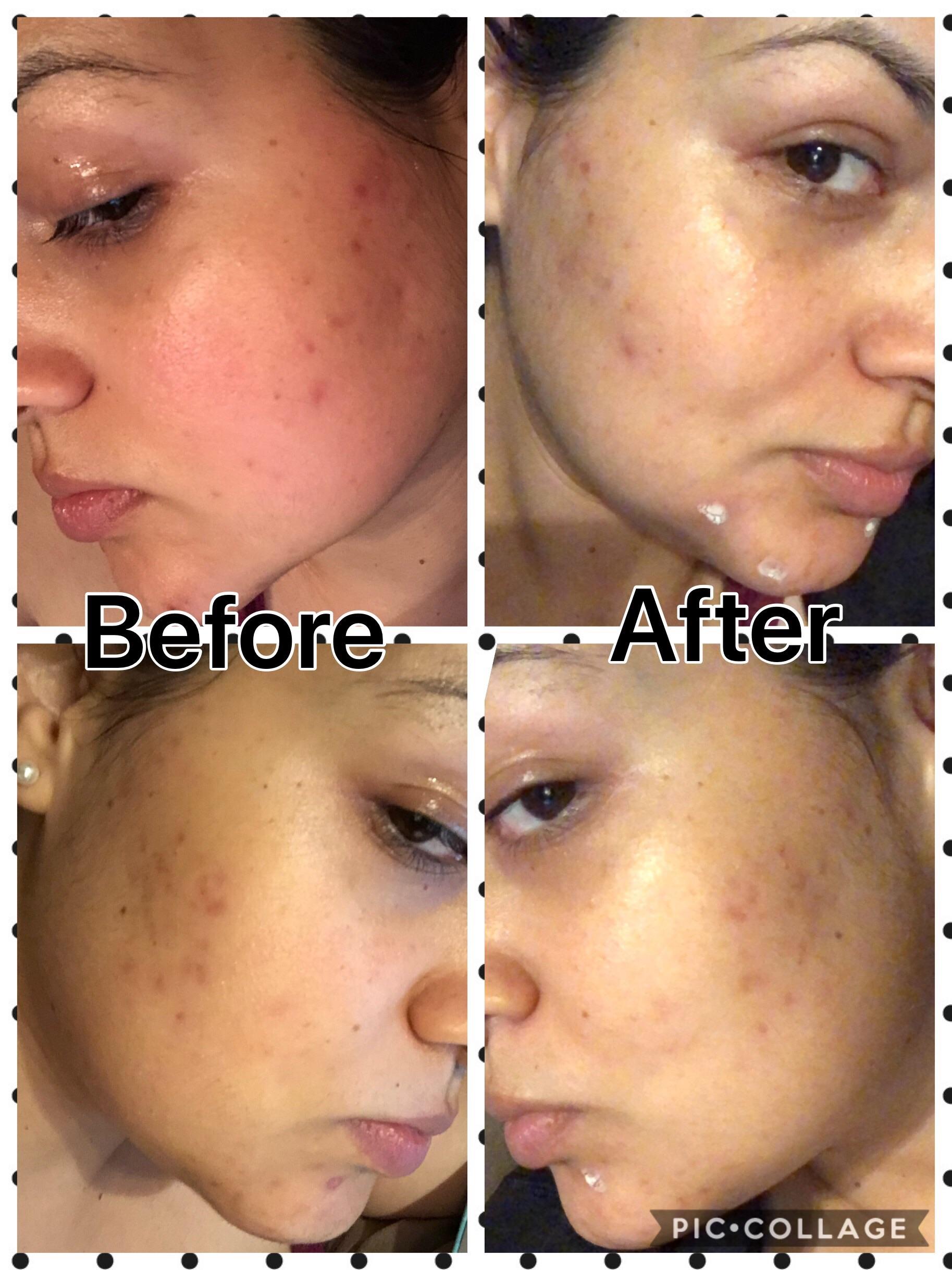 The Benefits Of Rosehip Oil For Your Skin Carhampt