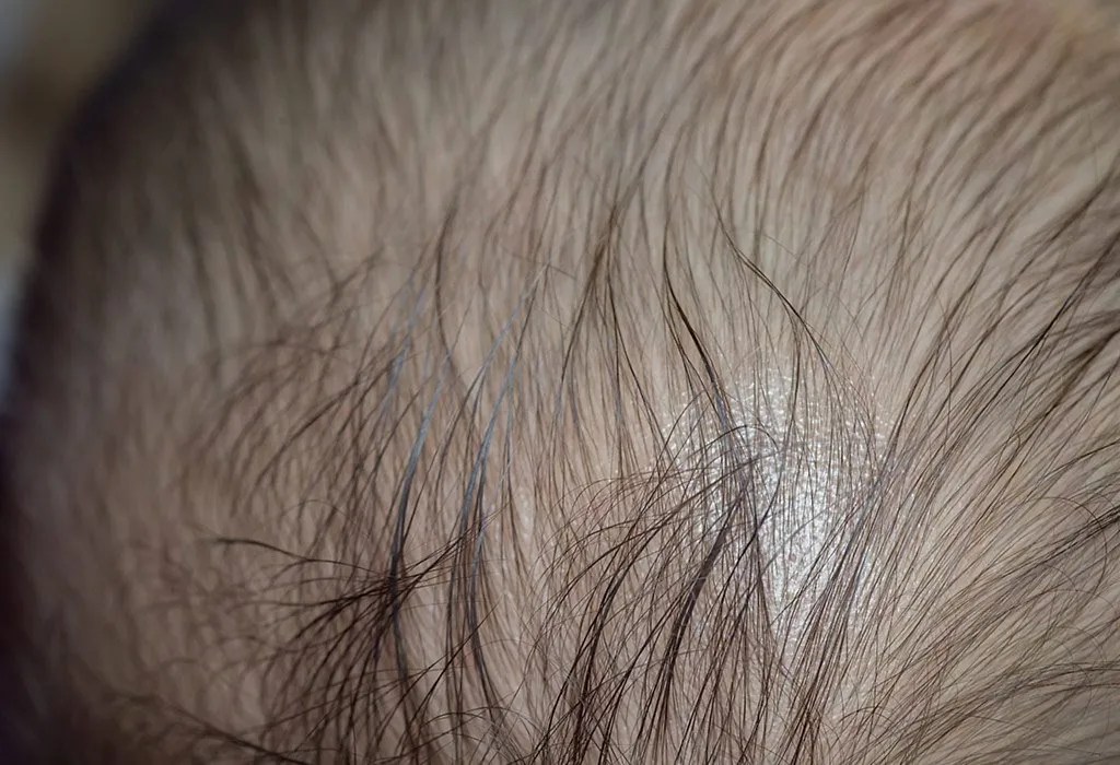 Alopecia Areata in Children Reasons, Signs & Treatment