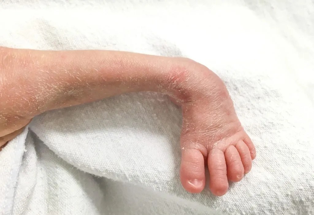 Club Foot In Infants Reasons, Signs & Remedies