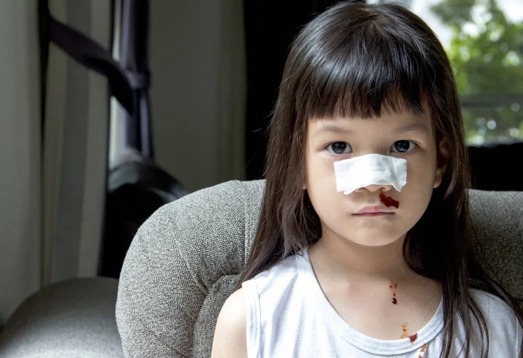 Nosebleeds In Kids - Types, Reasons & Treatment
