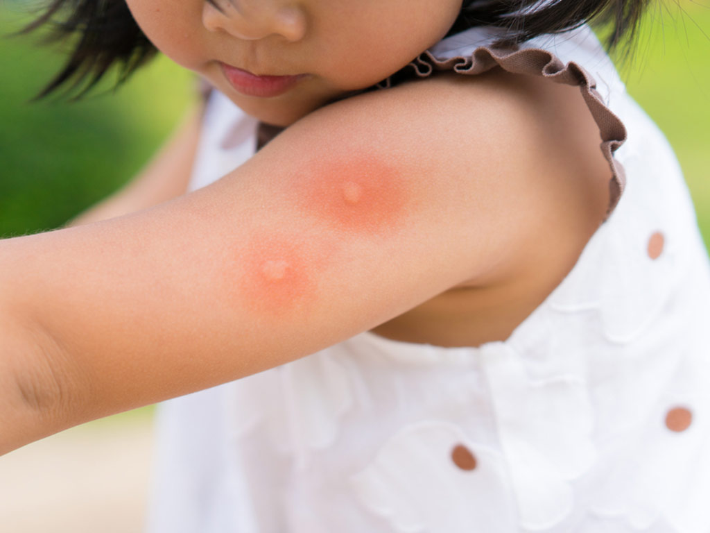 Dengue in Children Signs, Diagnosis & Treatment