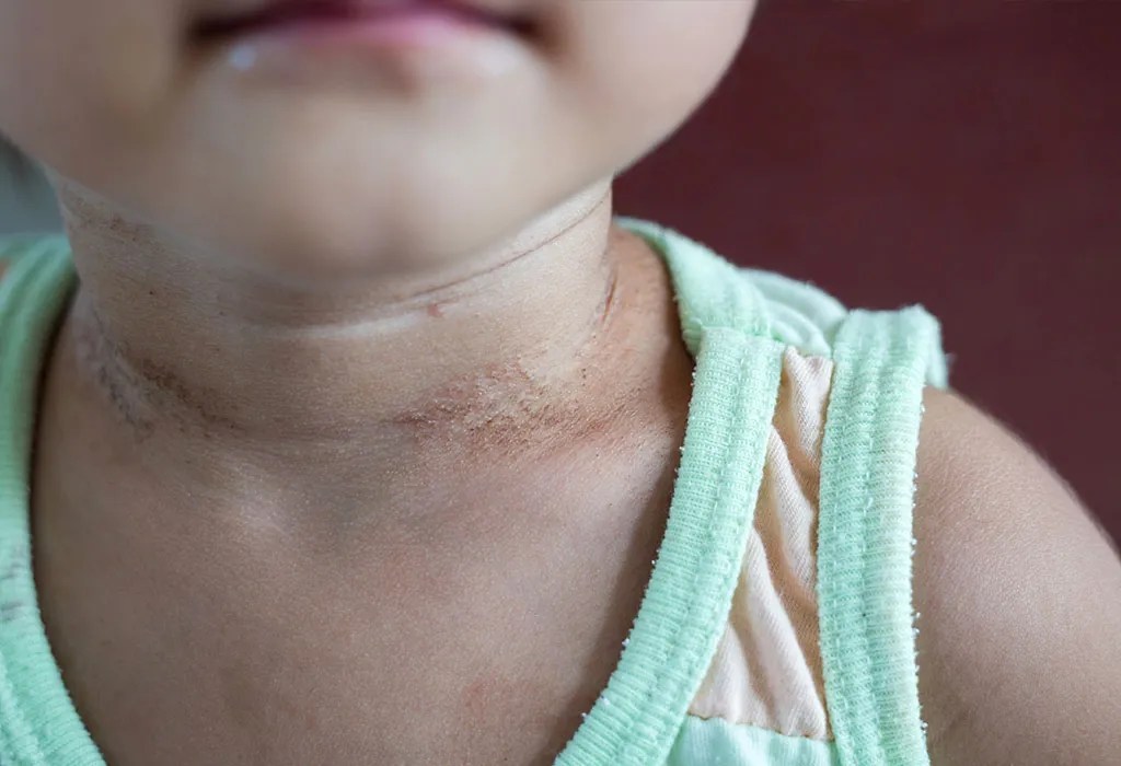 Neck Rash In Babies: Reasons, Symptoms, Treatment & Home Remedies