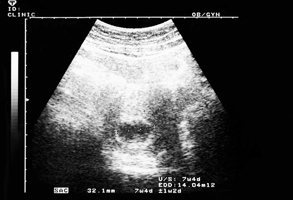 7 weeks pregnant ultrasound