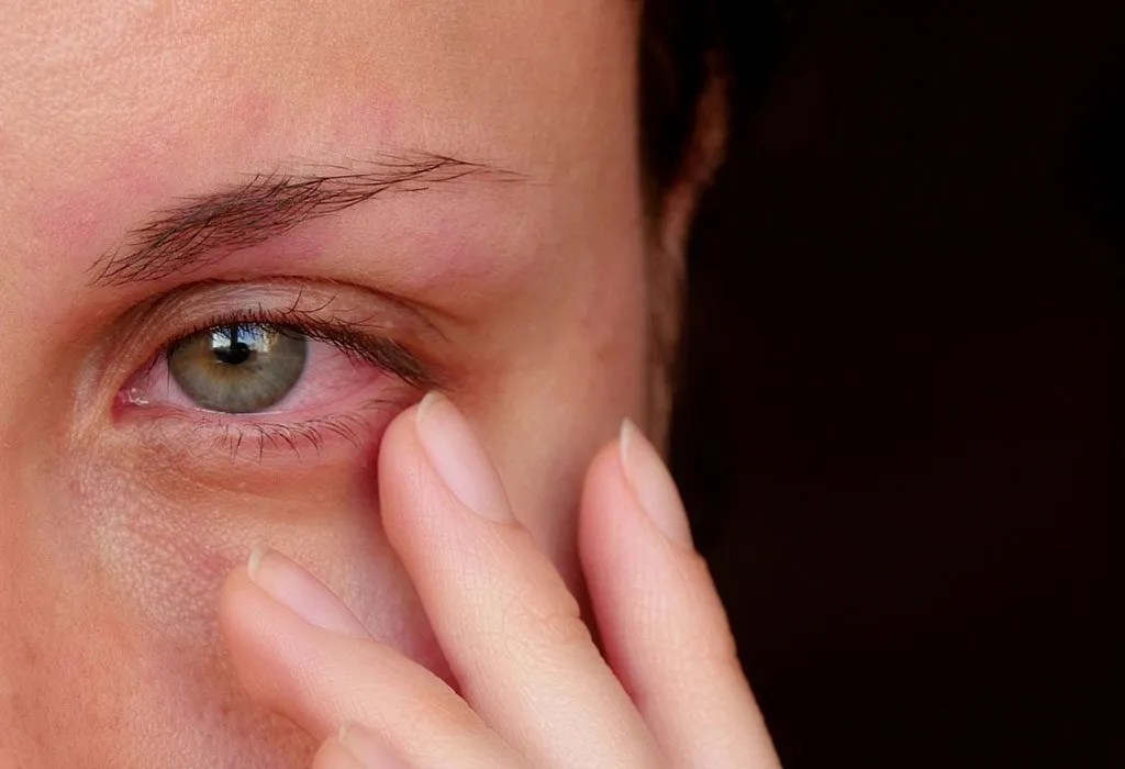 Conjunctivitis in Pregnancy Causes, Symptoms & Treatment