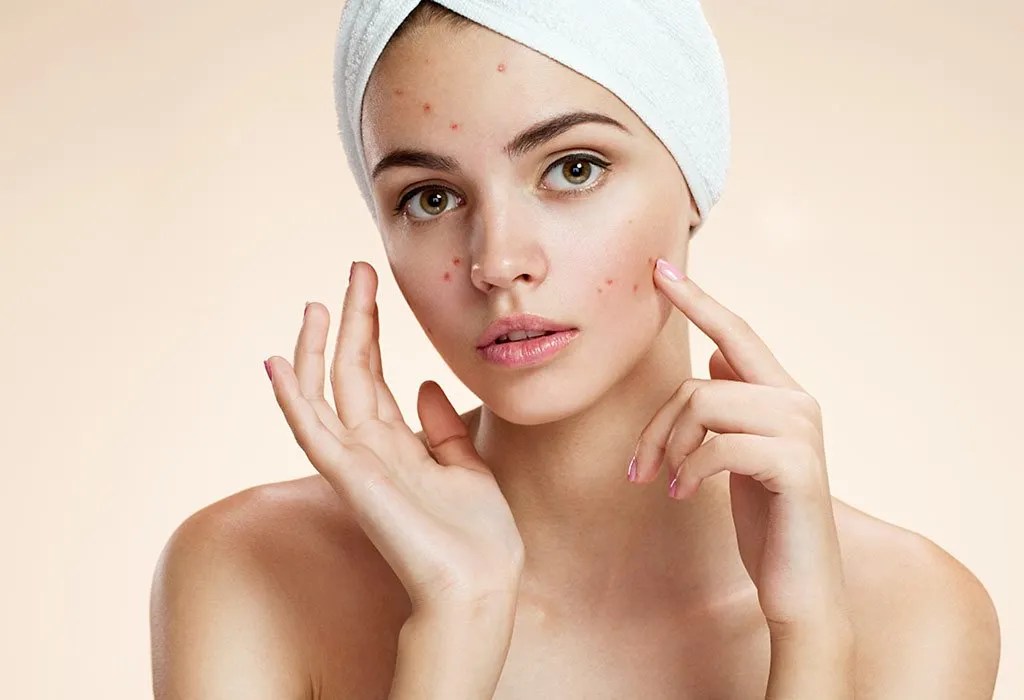 Pimples after Pregnancy Reasons, Prevention & Skin Care Tips