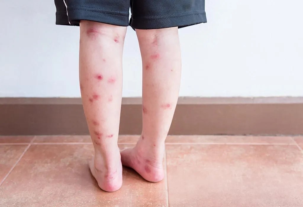 Scars in Children Causes, Treatment, Prevention & Home Remedies