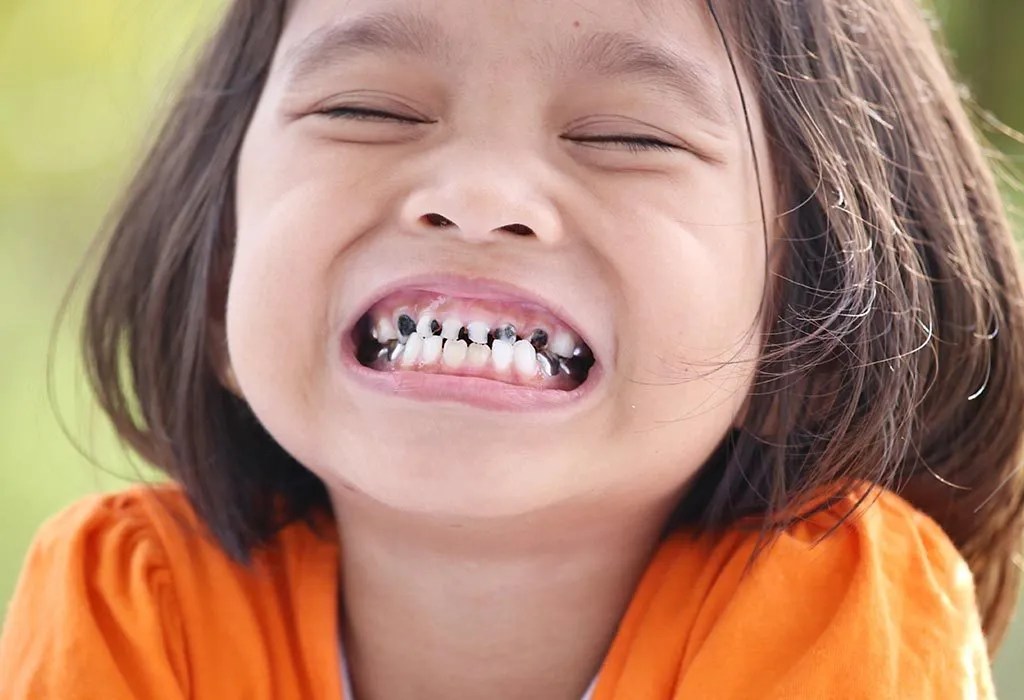 How to Deal With Chipped Tooth in Child?