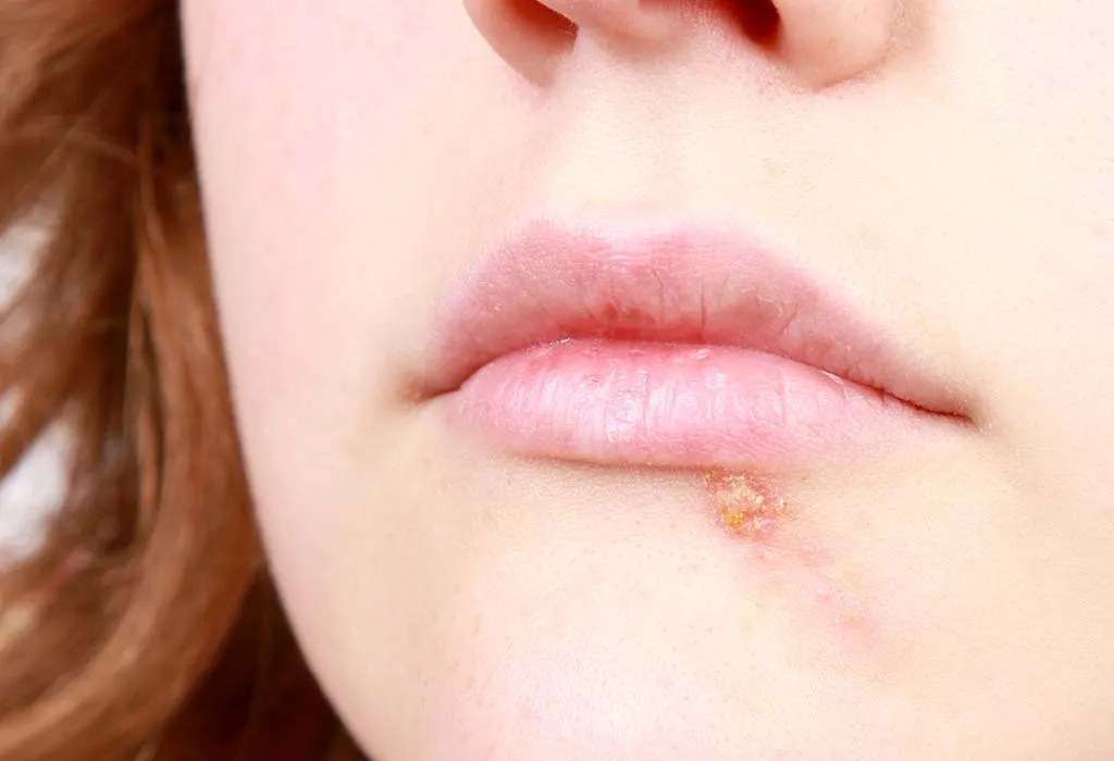 Cold Sores In Kids: Causes, Symptoms & Treatment
