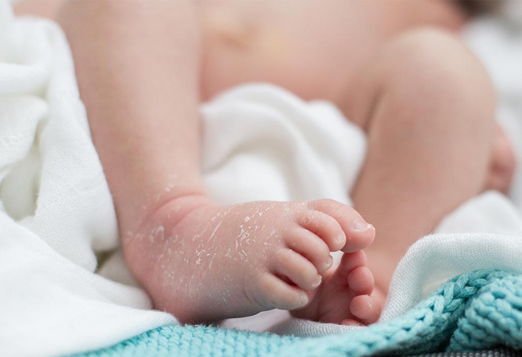 Urate Crystals in Baby's Diaper Causes & Tips to Deal WIth It