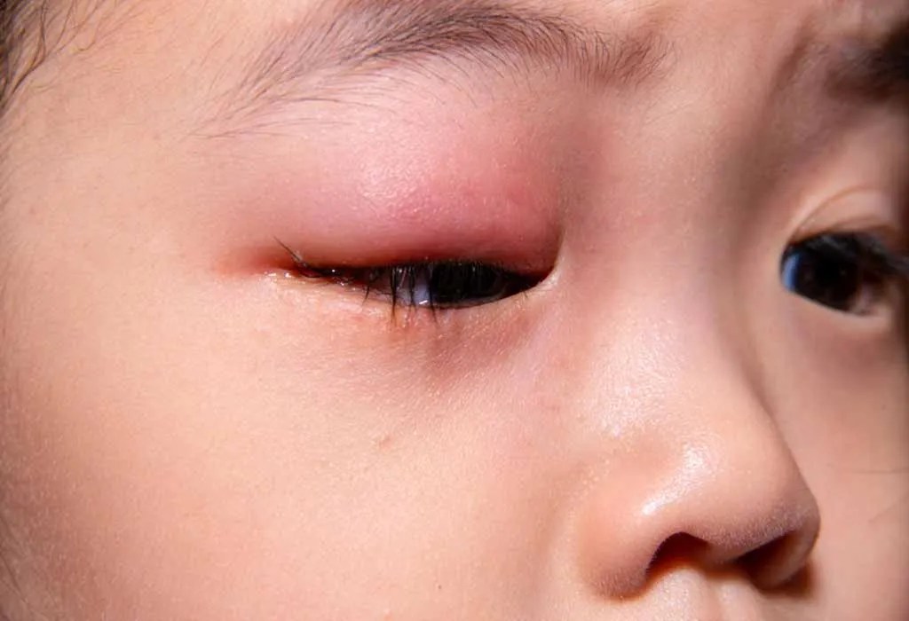 Stye in Child's Eye Types, Causes, Signs, and Treatment