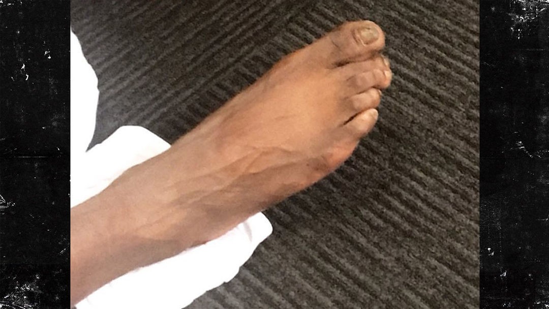 NBA's Reggie Jackson Reveals Jacked Up Feet!