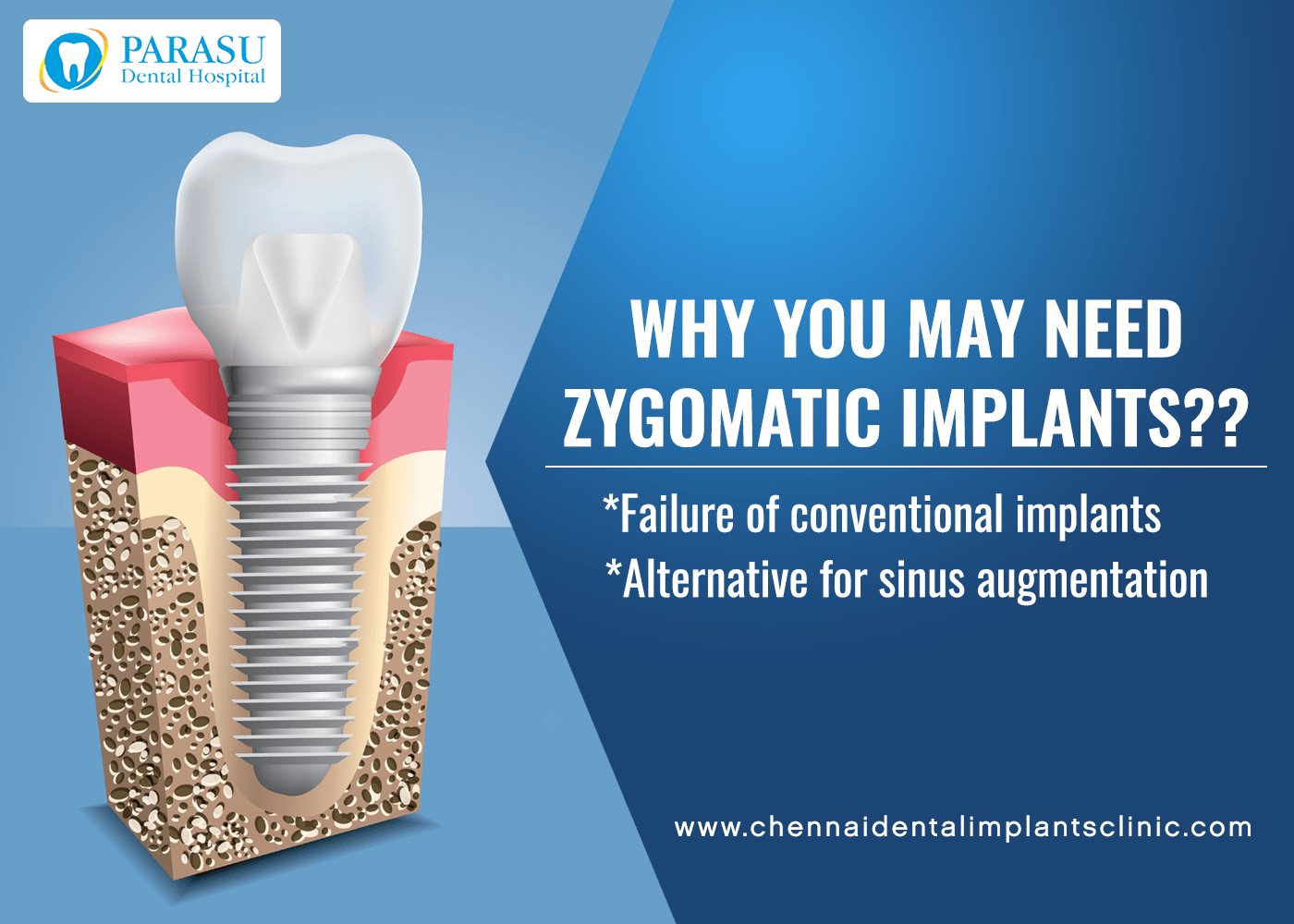 Exploring Zygomatic Dental Implants A Comprehensive Guide