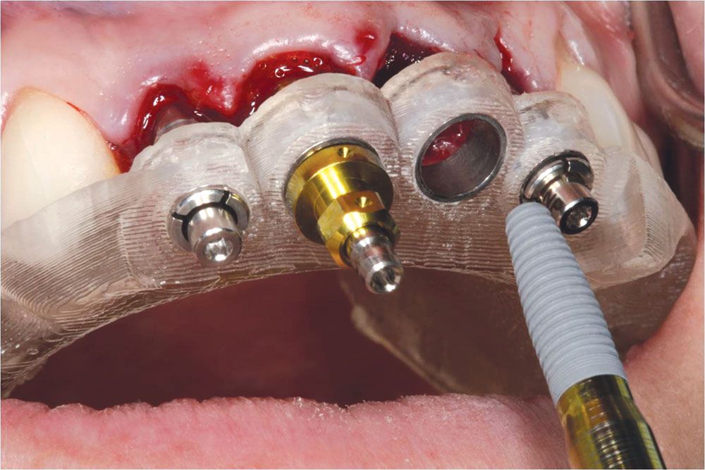 Can You Smile Confidently? Understanding Manulife Coverage for Dental Implants