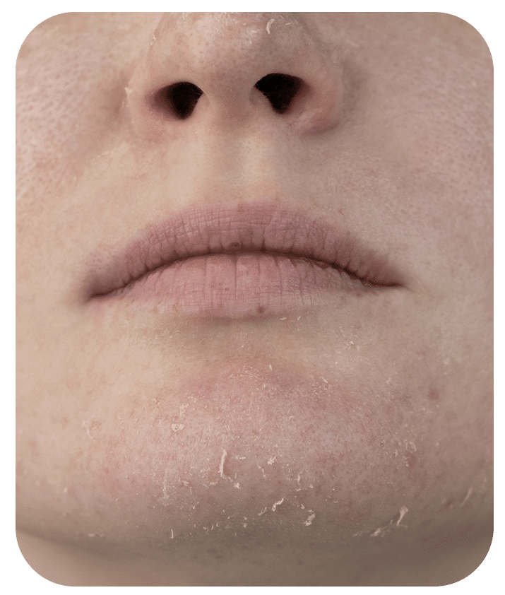 Hyaluronic Acid Gel Derma Made